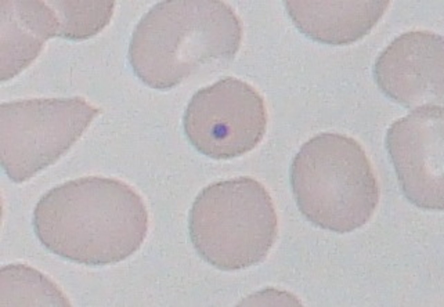 <p>Hyposplenism</p>