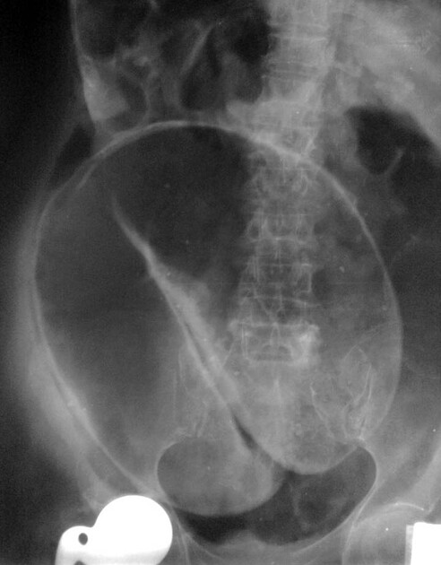 <p>What pathology is shown here?</p>