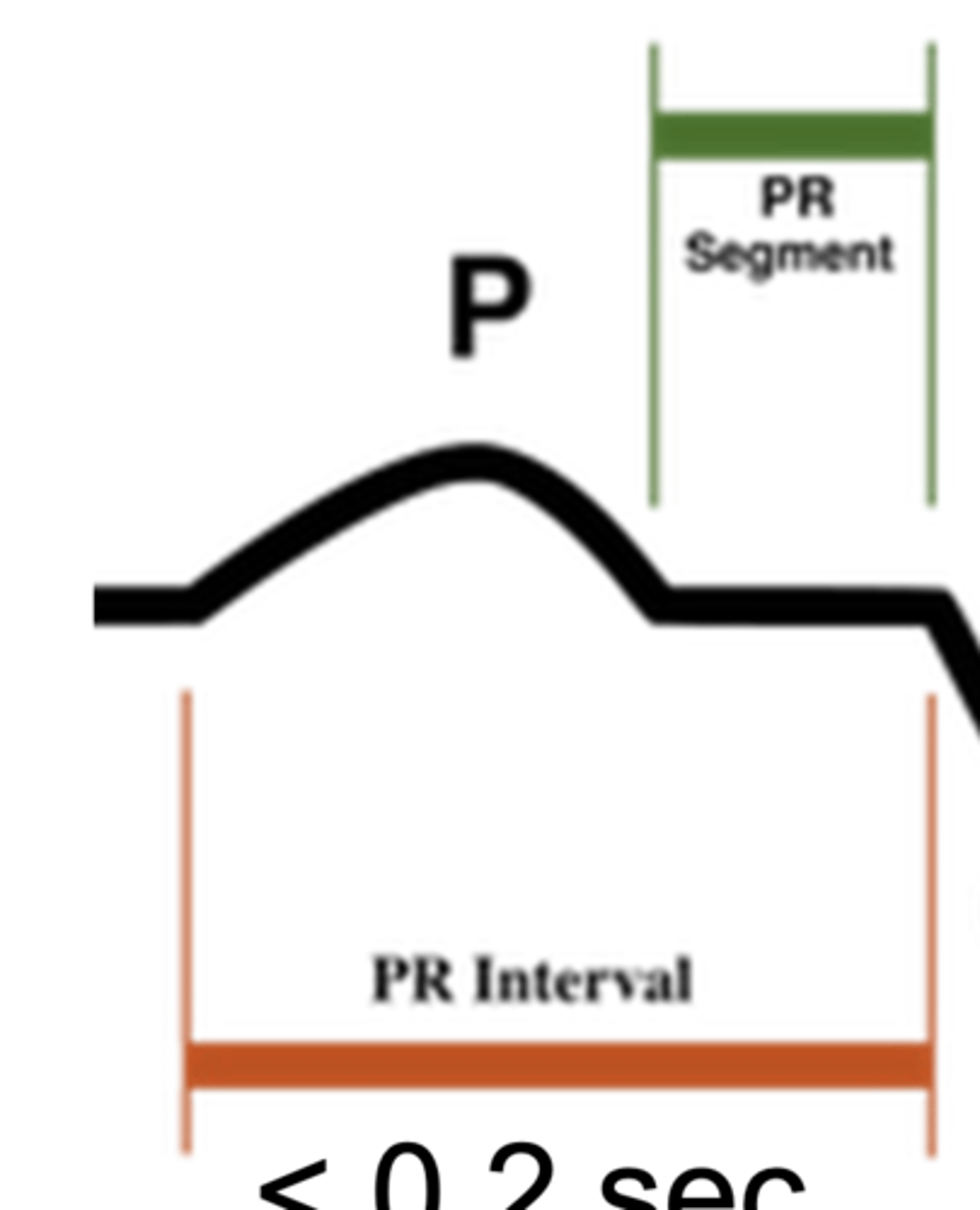 <p>atrial depolarization</p>