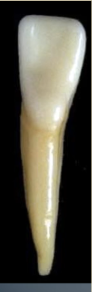 <p><mark data-color="red" style="background-color: red; color: inherit">mandibular central incisors #24 and #25; lingual view</mark></p>