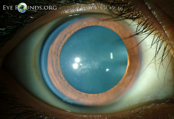 Fleischer’s ring, Vogt’s striae and apical scarring