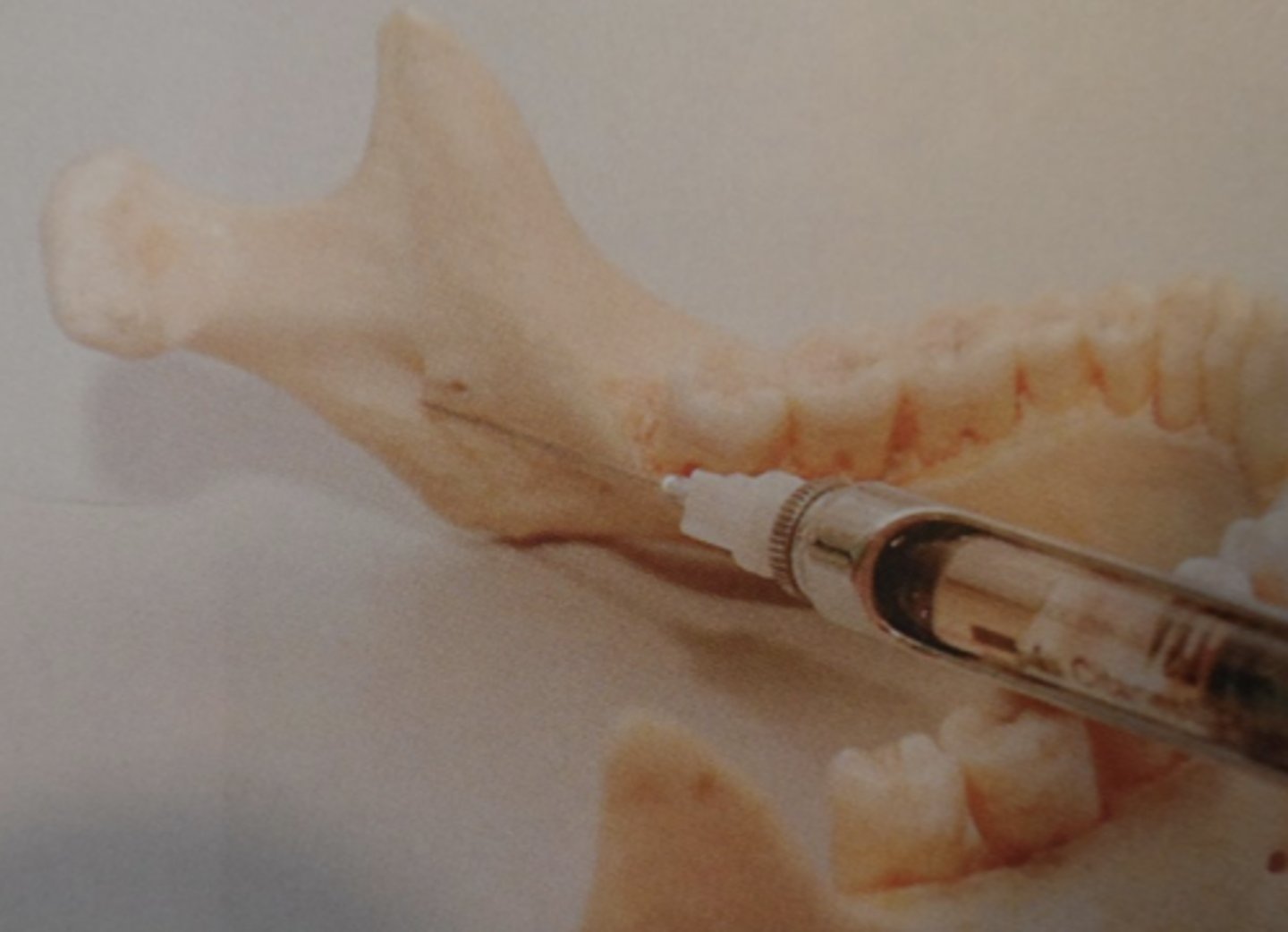 <p>(1) Direct intraneural injection w/ mechanical injury to the nerve</p><p>(2) interruption of vessels in mesoneurium -&gt; Hemorrhage -&gt; scar formation</p><p>(3) Chemical toxicity from contaminated carpules</p>