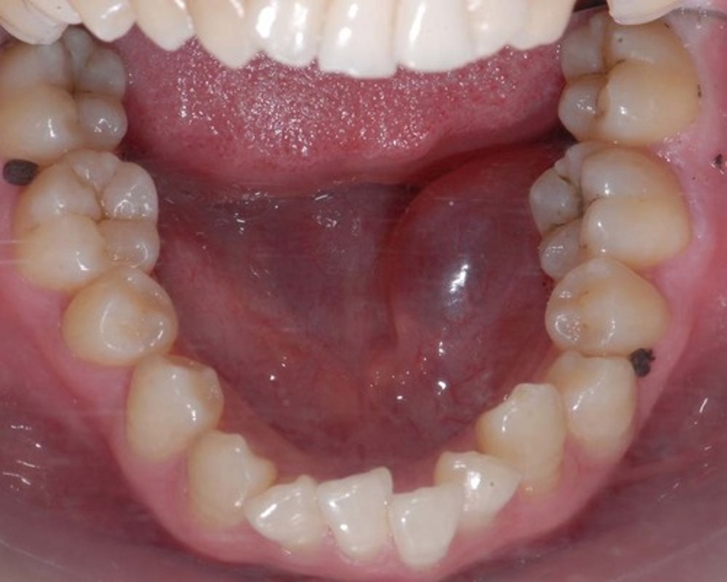 <p>Mucocele of the submandibular gland</p><p>- found in the base of the mouth</p>