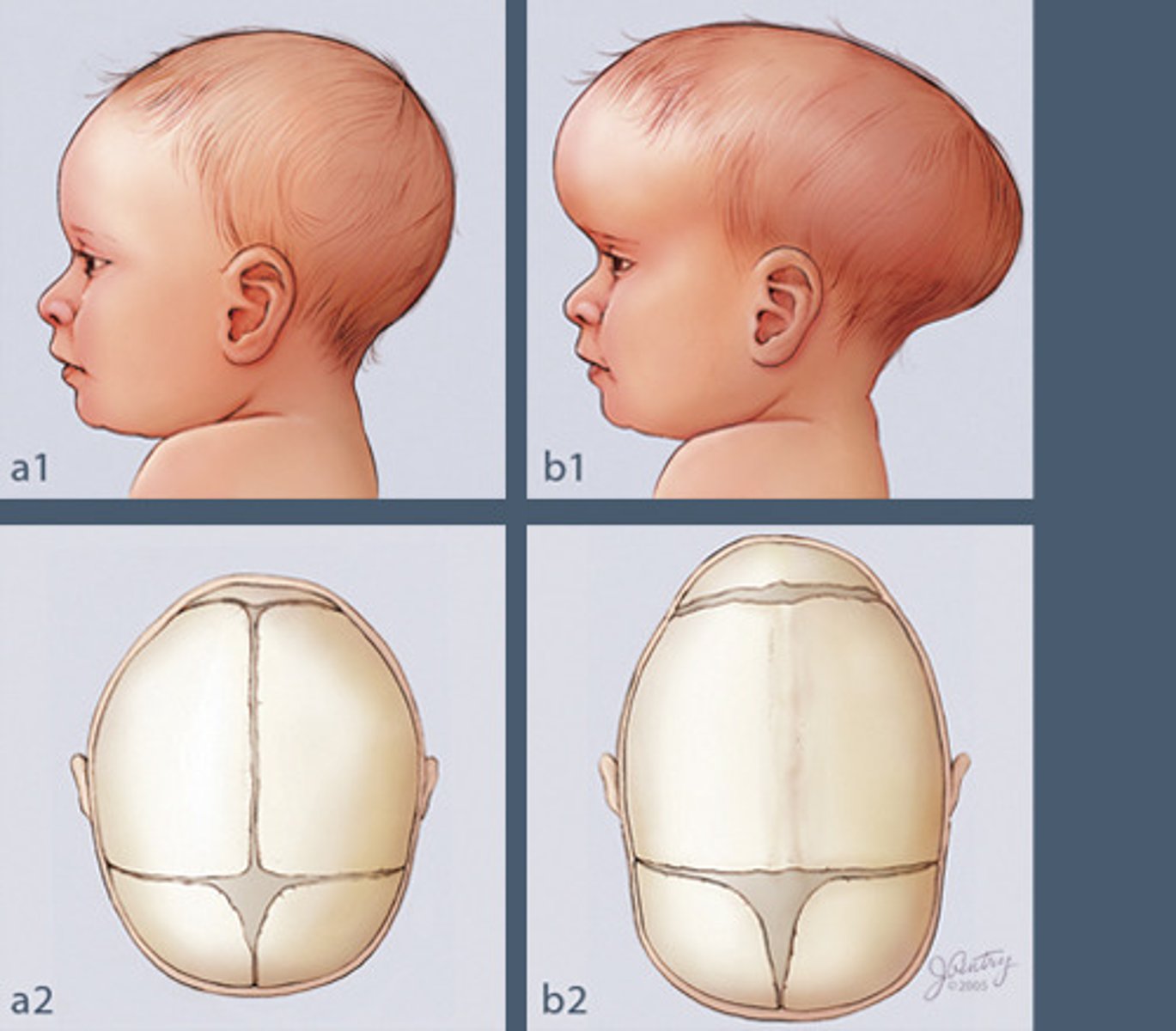 <p>Premature closure of cranial structures or fontanelles</p><p>- cranial asymmetry</p>