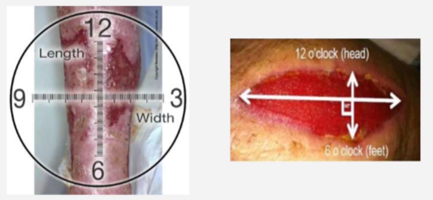 <p>assessment method for size measurement of wound</p><p>(in cm)</p><p>1. greatest length at longest point (12-6)</p><p>2. greatest width at widest point (9-3)</p><p>3. greatest depth from wound edge</p><p>(add clock location for added accuracy)</p><p>"12 o'clock" is ALWAYS towards the head of the patient</p>