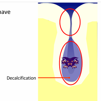 <p>-once the organic plug fails, bacteria have access to the depths of the fissure</p><p>-fissure walls are in close apposition</p><p>-unable to detect caries</p>