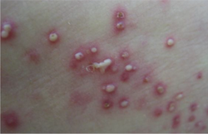 <p><span>Papules containing a purulent exudate that may be white, yellow, or greenish-yellow</span></p>