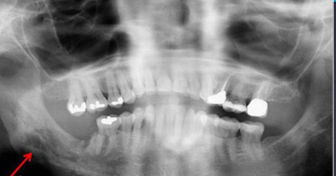 <p>current/previous treatment with antiresorptive medication and ho history of radiation therapy </p>