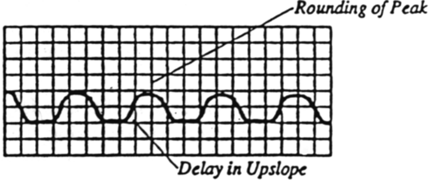 <p>Delayed upstroke</p><p>Rounded</p><p>Decreased amplitude</p>