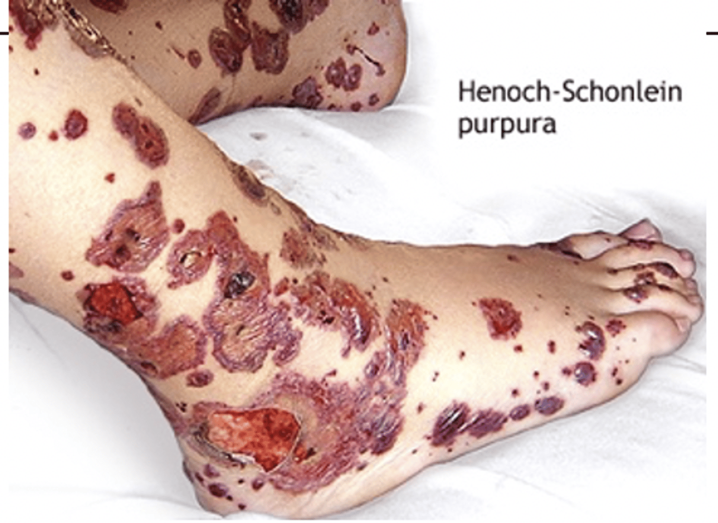 <p>- palpable purpura on legs</p><p>- joint pain (no swelling or warmth)</p><p>- abdominal pain</p><p>*at risk for intussusception (most commonly ileoileal)</p>