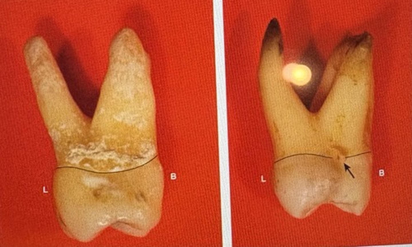 <p>False ; they are only are three visible form the distal view due to the mesial root being so wide</p><p>L is mesial view</p>