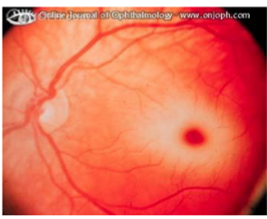 <ul><li><p><strong>At the macula</strong></p></li><li><p>Associated with central retinal artery occlusion</p></li><li><p>surrounded by pallor</p></li></ul><p></p>