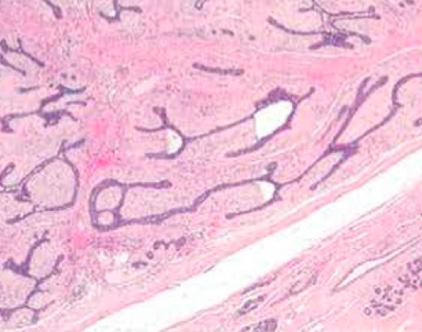 <p>An abnormal mass of cells that remains at its original site in the body. Not cancerous.</p>