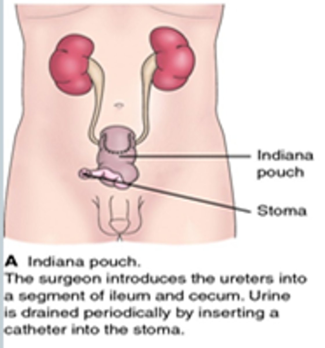 <p>continent cutaneous urinary reservoir</p><p>- portion of the large intestine and ileum used to form a urine pouch or reservoir</p><p>- clients can control the passage of urine using intermittent catheterization of this internal reservoir through a small stoma</p>