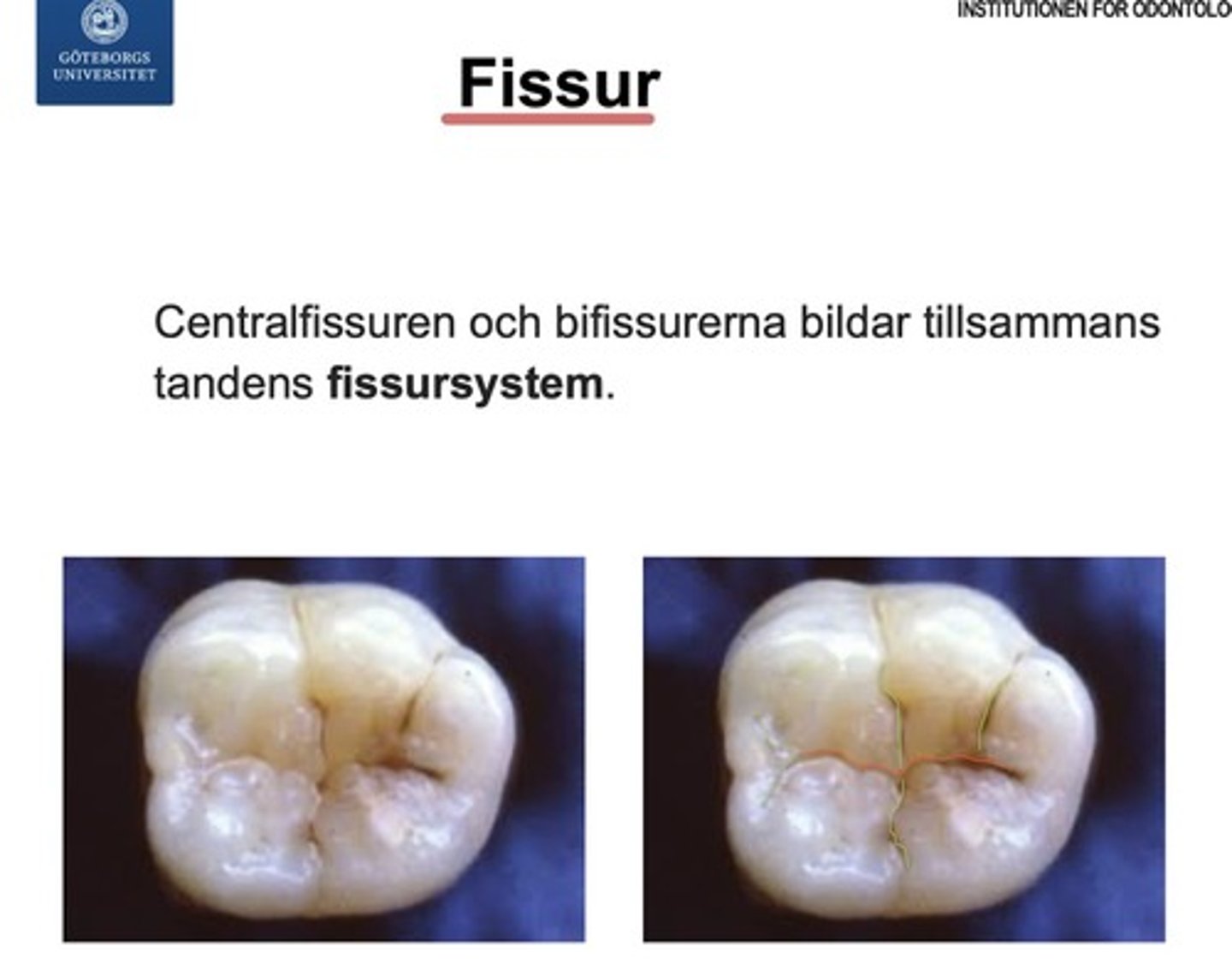 <p><span style="text-decoration:underline">Springor/fåror som finns på ocklusalytan.</span> </p><p>Ocklusalytan har en <strong><span style="text-decoration:underline">centralfissur</span></strong> i <span class="bgY">mesiodistal riktning,</span> från denna löper också <strong><span style="text-decoration:underline">bifissurer</span></strong> och tillsammans bildar de ett <strong><span style="text-decoration:underline">fissursystem</span></strong>. </p><p>Utformning och placering på fissurerna varierar mellan tandgrupp och individer.</p>