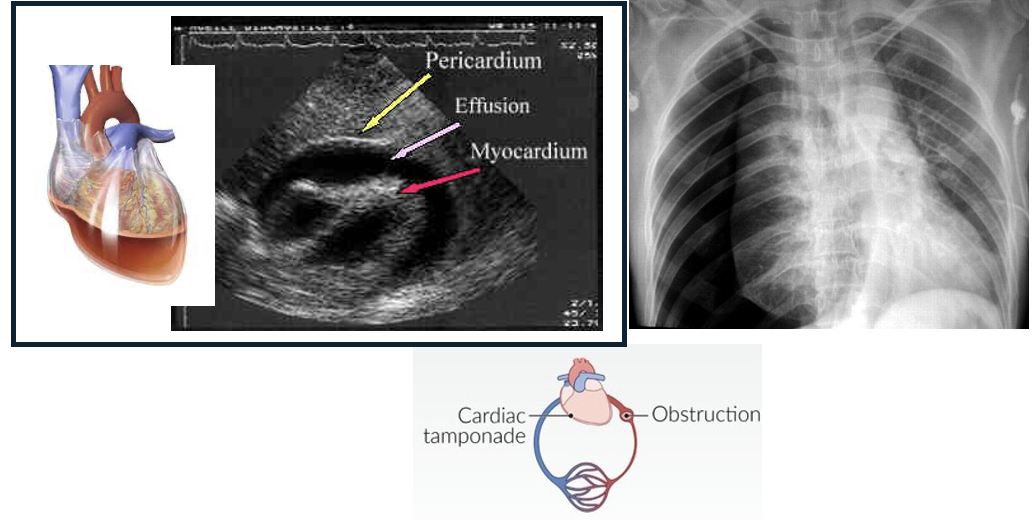<ul><li><p>Pneumothorax</p></li><li><p>Cardiac Tamponade</p></li><li><p>Pulmonary embolism </p></li><li><p>Pulmonary hypertension</p></li><li><p>Aortic dissection</p></li><li><p>Restrictive cardiomyopathy</p></li><li><p>Tumors</p></li><li><p>Sickle Cell Disease</p></li></ul><p></p>