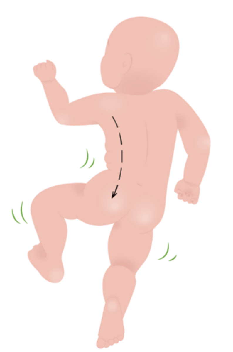 <p>Lateral curvature of trunk on stimulated side</p>