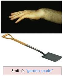 <p>Characteristics:</p><ul><li><p>Fracture of distal radius d/t fall on the back of flexed hand or blow to dorsal side of wrist</p></li><li><p>Fragment displaced in the palmar and anterior direction</p></li><li><p>“Garden spade” deformity</p></li><li><p>“Mrs. Smith loves to garden in her front yard”</p><ul><li><p>Mrs. Smith = Smith’s fracture</p></li><li><p>Garden = “garden spade” deformity</p></li><li><p>Front = volar/palmar/anterior</p></li></ul></li></ul><p>Presentations:</p><ul><li><p>Wrist pain, swelling, and deformity</p></li><li><p>Limited ROM</p></li><li><p>Tenderness over distal radius</p></li></ul><p>Complications:</p><ul><li><p>Complex regional pain syndrome</p></li><li><p>Malunion</p></li></ul><p></p>