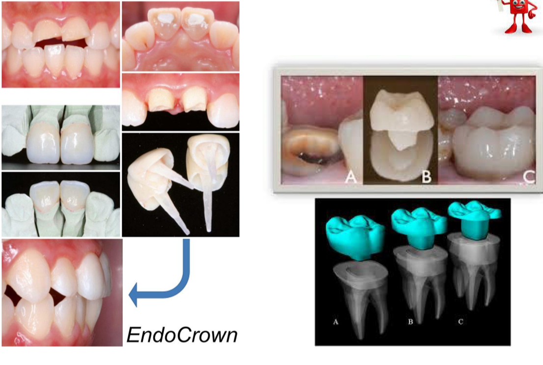 <p>Type of crown designed for a tooth that’s undergone RCT or has significant structure loss </p><p>endocrowns are anchored within tooth structure extends in pulp chamber for stability </p>