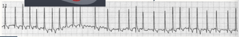 <ol><li><p>narrow, upright QRS complexes</p><ul><li><p>irregular ventricular rate</p></li><li><p>absence of P wave</p></li><li><p>irregular RR interval</p></li><li><p>undulating baseline</p></li></ul></li><li><p>tachycardic, pulse deficits</p></li><li><p>re-entry, triggered activity</p></li></ol><p></p>