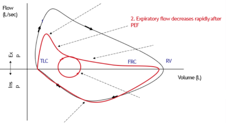 <p><span>Expiratory flow decreases rapidly after PEF</span></p><ul><li><p><span>Due to narrowing of airways (loss of tethering force so can’t get same flow due to higher resistance)</span></p></li></ul>