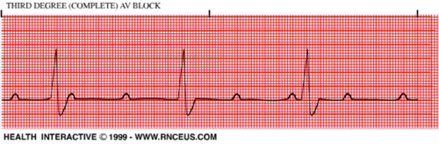 <p>P and QRS are NOT communicating (atrial and ventricles function normally, but are completely dissociated)</p><p>AV node cannot conduct impulses, ventricles generate an escape rhythm (20-40 bpm)</p><p>PR interval = cannot determine (random P waves)</p>