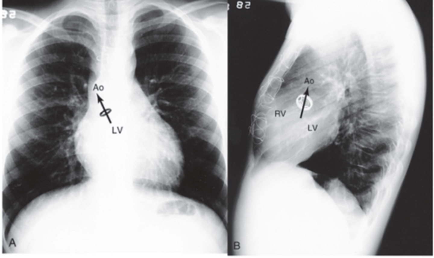 <p>- located at the root of the ascending aorta</p>