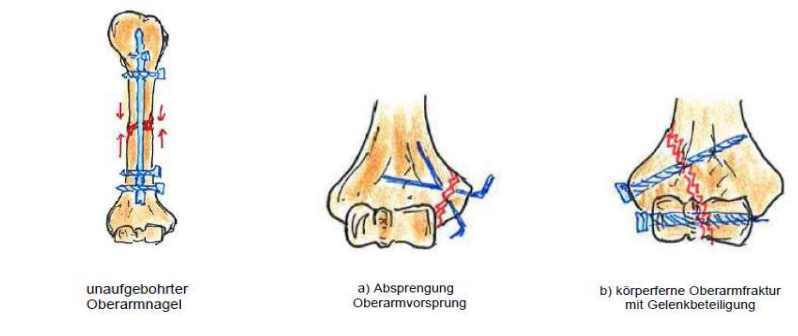 <p>Oberarmfraktur</p><ul><li><p>Schaft &amp; distales Ende - einfach</p></li><li><p>Druck ist wichtig</p></li></ul><p></p>
