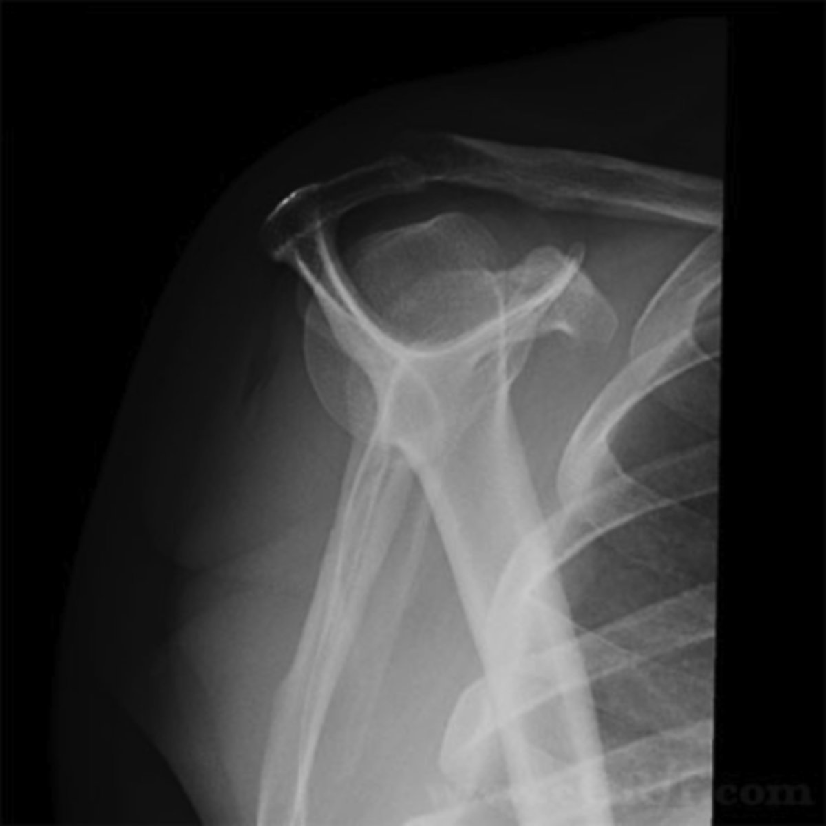 <p>1. What projection is shown in the image?</p><p>2. What are the clinical indications for this projection?</p><p>3. Is this an optimal image?</p><p>4. Name all of the anatomy.</p><p>5. Does this image meet all criteria?</p><p>6. Where is the CR placed?</p><p>7. If applicable, what method is interchangeable with this projection?</p>