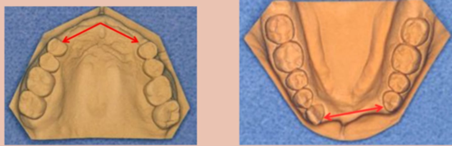 <p>Tooth and tissue supported, tooth supported:</p><p>A single but bilateral (crossing the midline) edentulous area located anterior to the remaining natural teeth</p>