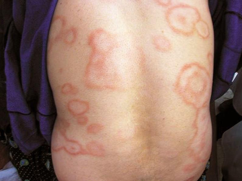 <p>a) Erythema marginatum</p><div data-type="horizontalRule"><hr></div><p>Pink torso rings</p>