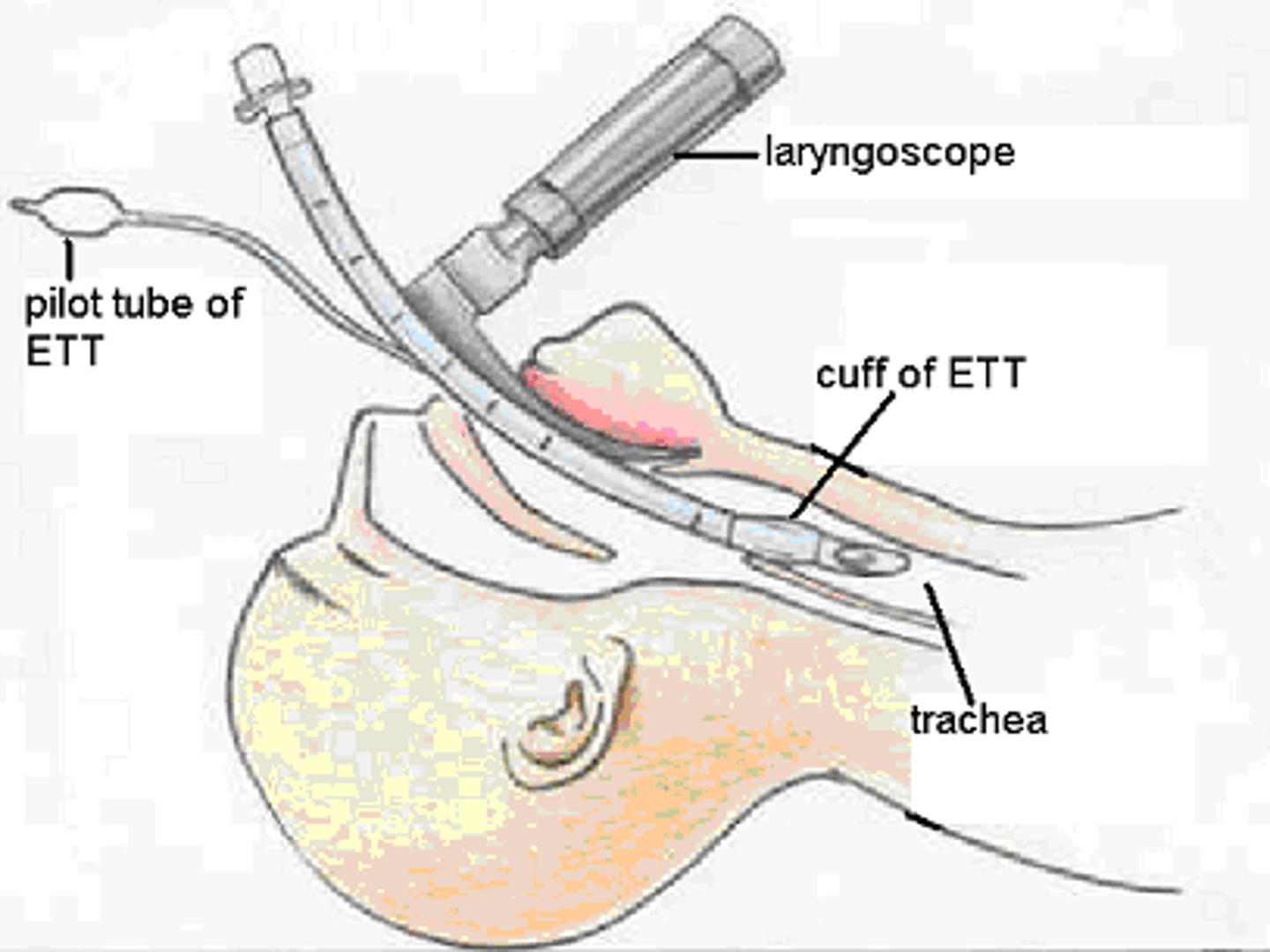 <p>placement of a tube through the mouth into the pharynx, larynx, and trachea to establish an airway</p>