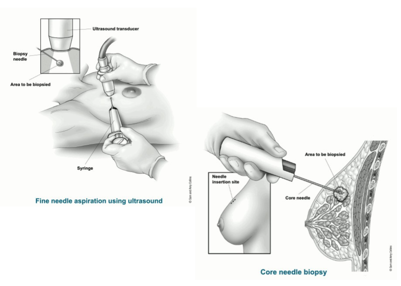 <p>It tells you what type of lump it is —</p><ul><li><p>Fluid-filled = cyst</p></li><li><p>Solid = possible tumor<br>It’s like asking, “Is the lump squishy or solid?”</p></li></ul><p></p>