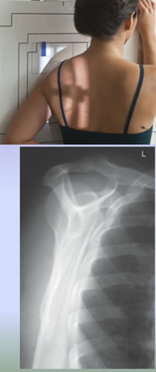 <p>patient in 60° anterior oblique, CR perpendiclar mid body of scapula</p>