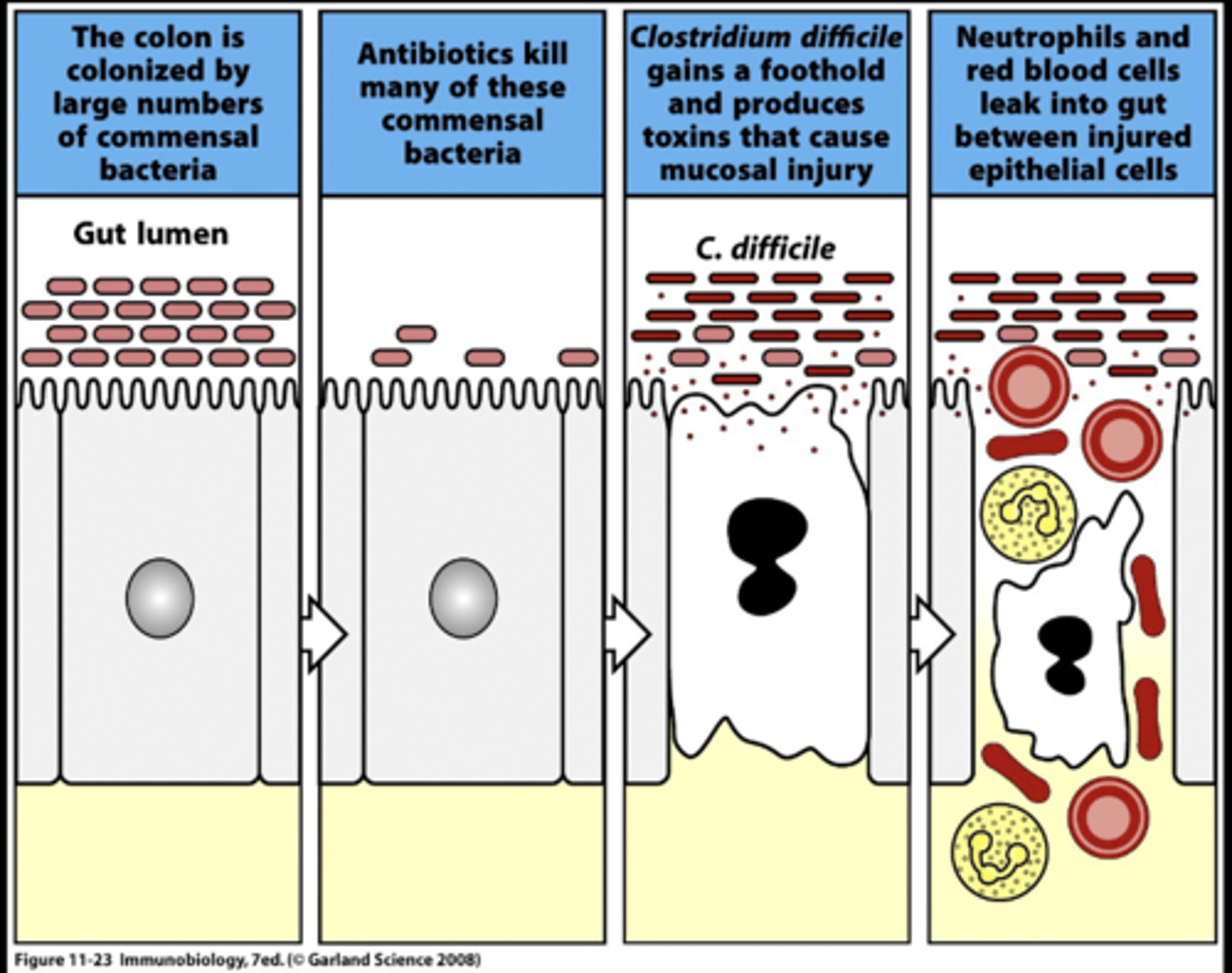 <p>C. Difficile diarrhea - inflammatory diarrhea</p><p>Persistent infection following antibiotic treatment</p><p>Frequent relapse rate</p><p>Development of pseudomembranous colitis</p><p>Cause of death of 30,000 people</p>