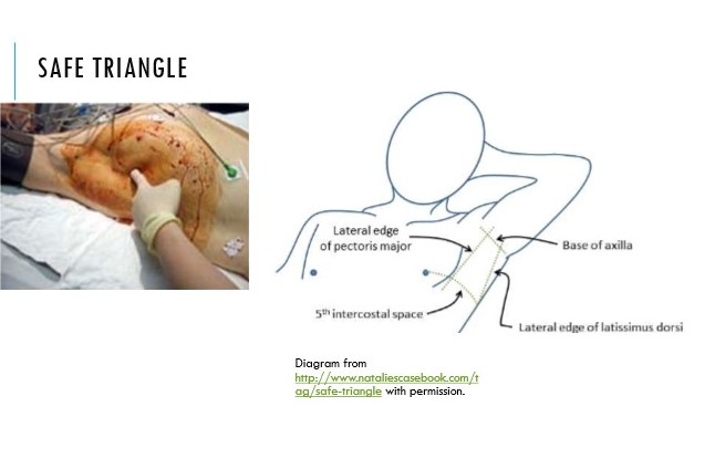 Location used when aspirating pneumothorax

\
Needle inserted right above rib to avoid neurovascular bundle

\
Boundaries: latissimus dorsi, pec major, line superior to nipple + apex at axilla