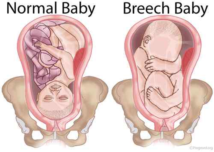<p>Complete breech</p>