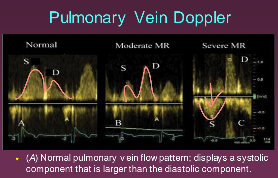 <p>Using PW Doppler by placing the PW sample volume approx. 1 cm into the RUPV from the A4 or A5 view. This is done when there is grade 4 MR to see how far back the leaking is occurring. This is an additional picture that must be taken per protocol in a case of grade 4 MR.</p>