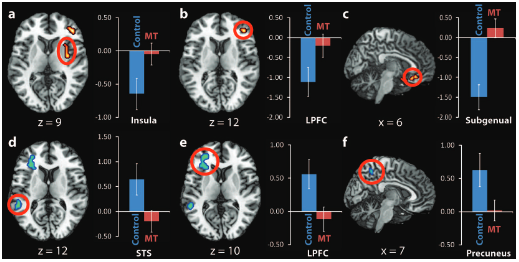 <p>Compares brain activity during sad vs neutral clips to show how the mindfulness groups responses differed from controls, revealing reduced activation and deactivation patterns after mindfulness training. </p><p>A-C = areas deactivated with sadness in controls, but not in MT</p><p>D-F = areas activated with sadness in controls, but not in MT</p>