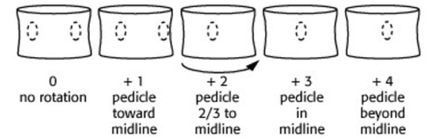<p>Pedicle movement on the CONVEX side</p><p>Graded 0-4 at the apex of the curve</p>
