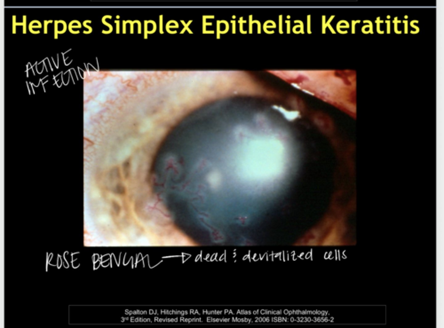 <p>Herpes Simplex Epithelial Keratitis -- Stain w/ Rose Bengal (Pic)</p>