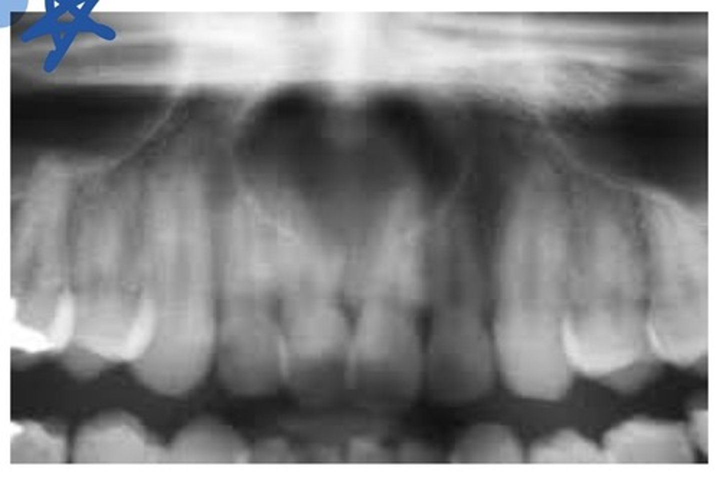 <p>This is a cyst located within the nasopalatine canal or the incisive papilla. More common in men, 40-60 yrs. Usually asymptomatic. May see a small, pink bulge near the apices and between the roots of the maxillary central incisors on the lingual surface. Client may have a salty taste (nasal fluid salty).</p>