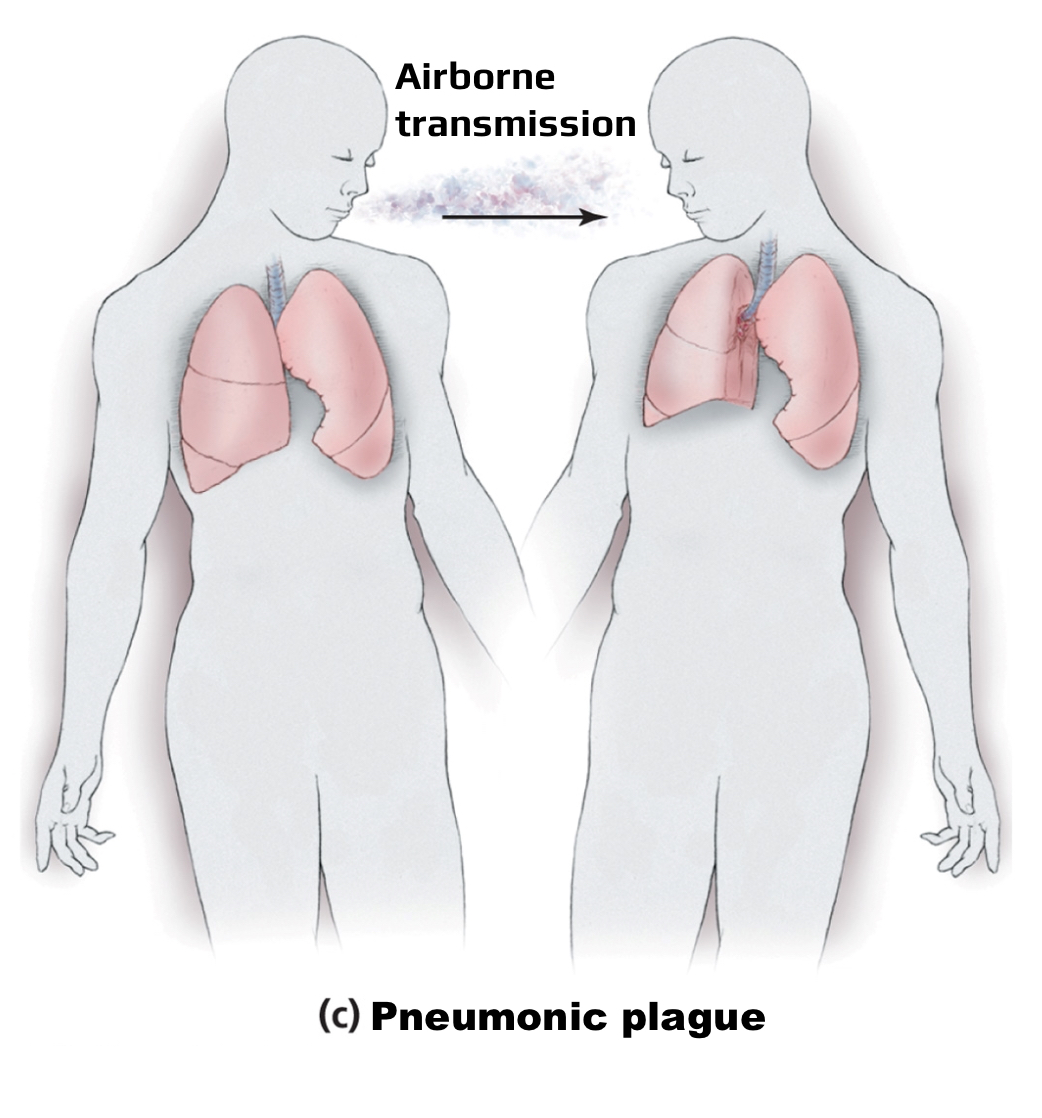 <p><span style="background-color: transparent;"><span>Agent: </span><em><span>Yersinia pestis</span></em></span></p><p>Transmitted through: inhalation human to human</p><p>Symptoms: <span style="background-color: transparent;"><span>cough, difficulty breathing, and </span><strong><span>frothy bloody sputum</span></strong></span></p><p>Causes pneumonia </p>