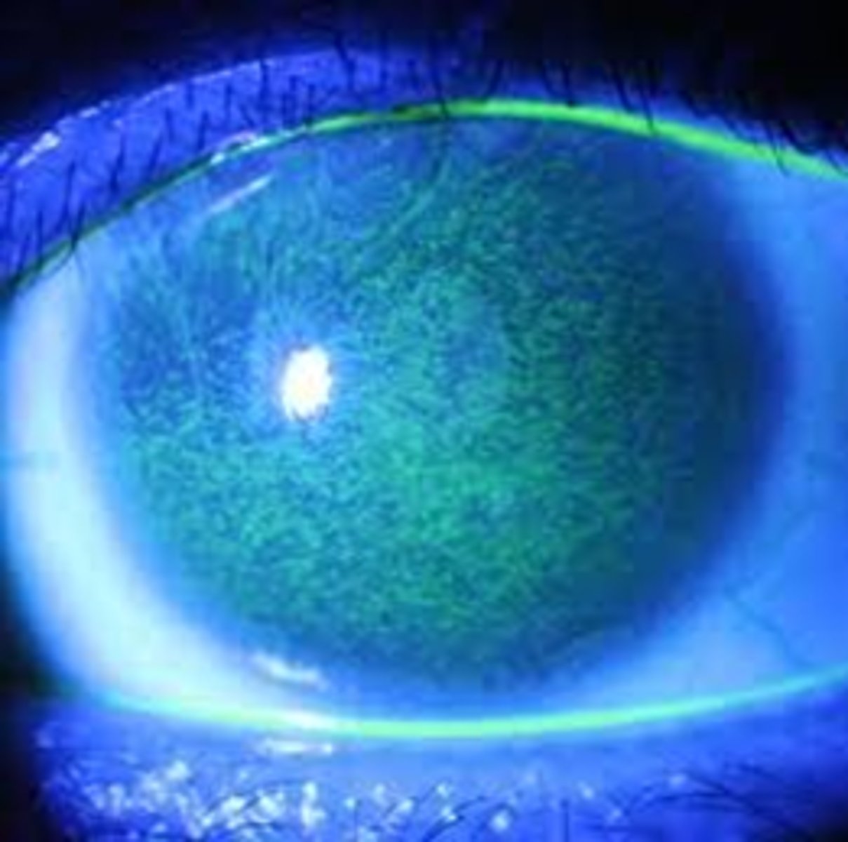 <p>C</p><p>solar keratitis</p>