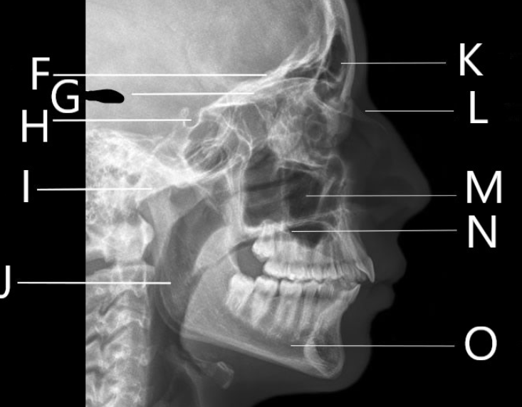 <p><strong>What is G identifying?</strong><br>A. Horizontal plates of the frontal bone<br>B. Greater wing of the sphenoid<br>C. Sella Turcica<br>D. Vomer</p>