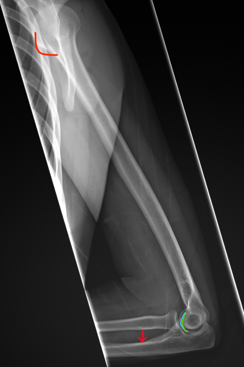 <p>Humeral Rot.</p><ul><li><p>LT in profile medially</p></li></ul><p>Elbow Rot. (optimal lat elbow)</p><ul><li><p>cap and troch SI ant/post</p></li><li><p>open elbow joint</p></li><li><p>ulna is distal from the radius due to diverging beam</p></li></ul><p></p>