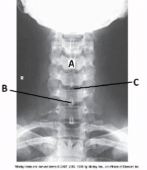 <p><span>How is the central ray directed to obtain this image?</span></p>
