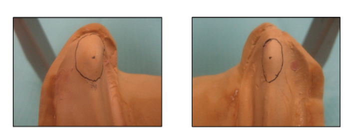 <p>Place a dot anterior 2/3 of the height of each retromolar pad </p><ul><li><p>anterior 2/3 is the posterior aspect of the occlusal plane</p></li><li><p>(make dots/reference points while holding cast at eye level and look at it from the facial aspect)</p></li></ul><p></p>