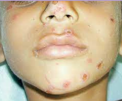 <ul><li><p>Inconsistent history given when caregivers are interviewed separately.</p></li><li><p>Delay in seeking treatment by the caregiver.</p></li><li><p>Uniform appearance of the burn, with clear delineation of the burned and non-burned areas (as with a hot object applied to the skin, e.g., cigarette burns).</p></li><li><p>In the case of scald-induced burns, lack of patterning of water but evidence of so-called “porcelain-contact sparing,” where the portion of the child’s skin that was in contact with the tub or sink is not burned (commonly seen with forced immersion in extremely hot water used as punishment).</p></li><li><p><strong>Flexor-sparing</strong> burns or burns that involve the dorsum of the hand.</p></li><li><p>A <strong>stocking/glove</strong> pattern on the hands or feet (circumferential ring appearing around the extremity, resulting from a caregiver forcefully holding the child under extremely hot water).</p></li></ul><p></p>