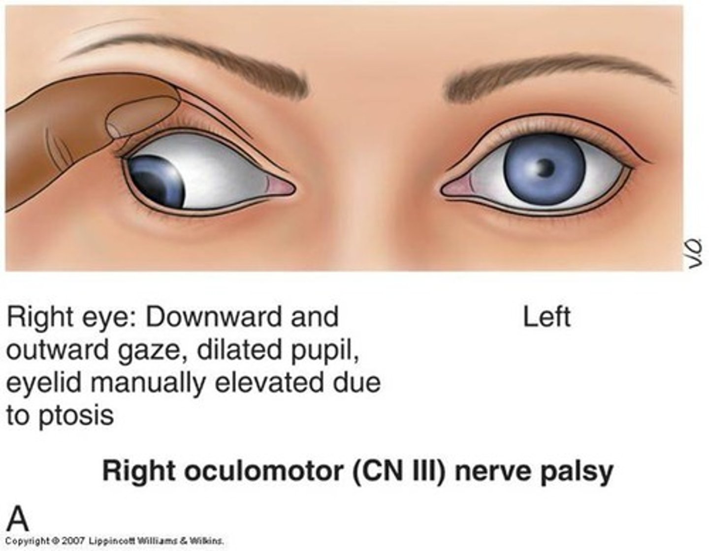 <p>Decreased strength of a muscle, which produces a reduced rotational movement of the eyeball in the direction corresponding to the paralyzed muscle</p>
